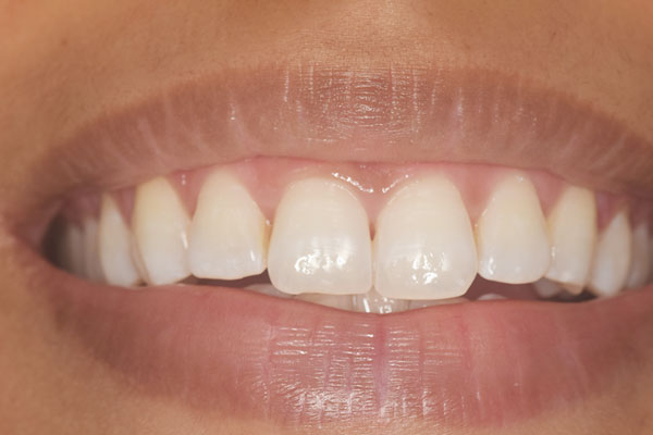 Bleaching