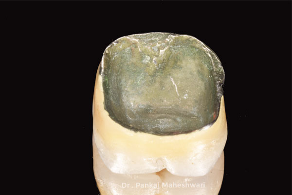 Dental Caps