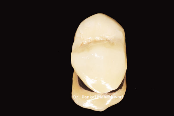 Porcelain Fused to Precious Metal