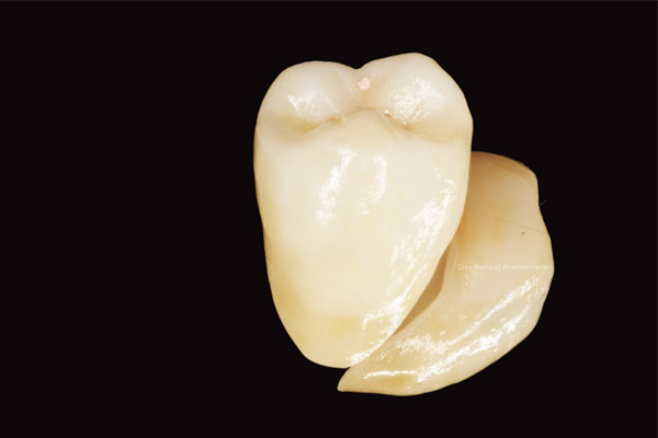 Zirconia layered with Porcelain