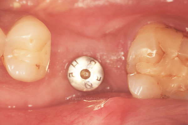 Implant
