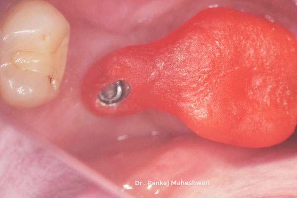 Implant