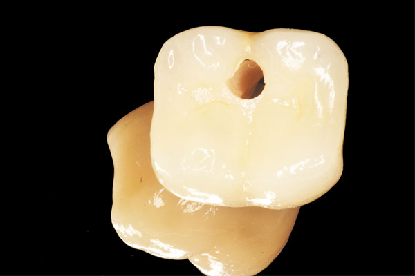 Implant