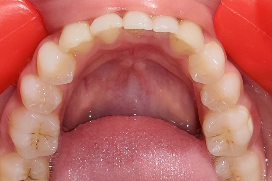 Braces for a Beautiful smile
