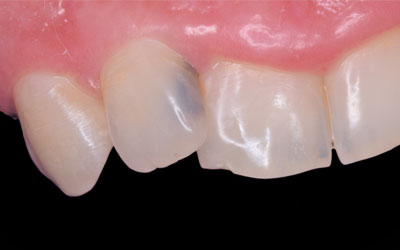 Cavity in Front Teeth