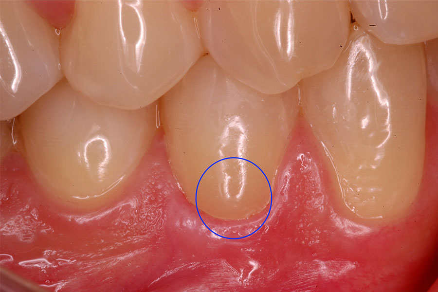 Cervical Erosion