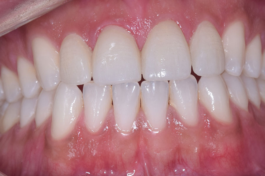 Close Front Tooth Gaps with Laminates