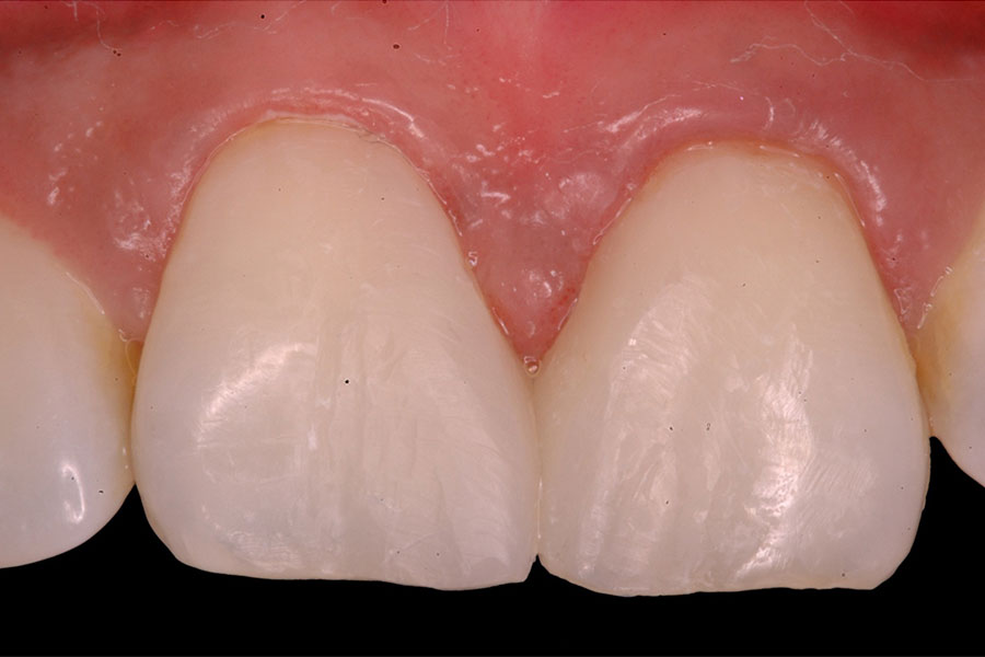 Fissure sealents