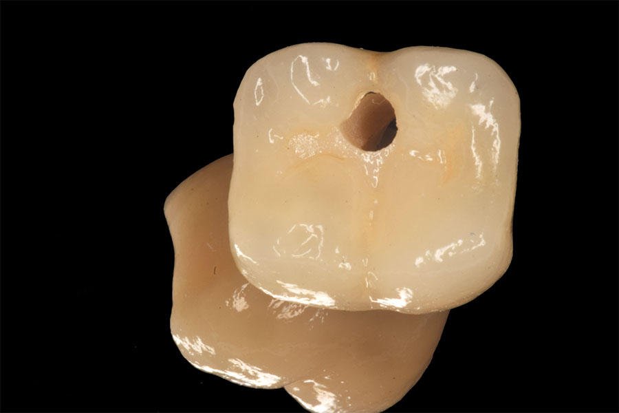 Dental Implants