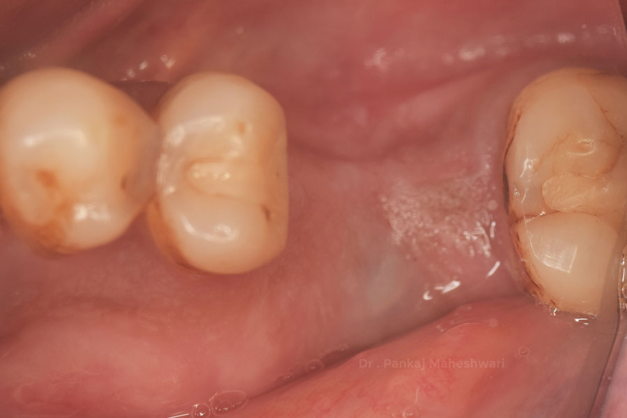 Dental implant