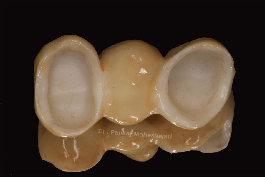 Dental bridge