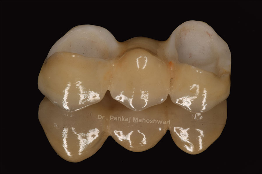 Dental Bridges