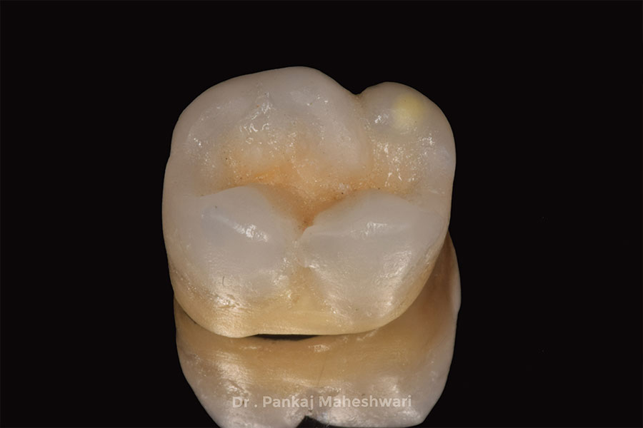 Dental cap