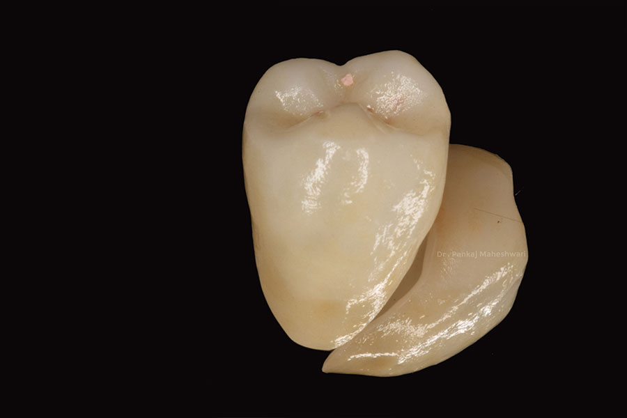 Dental cap