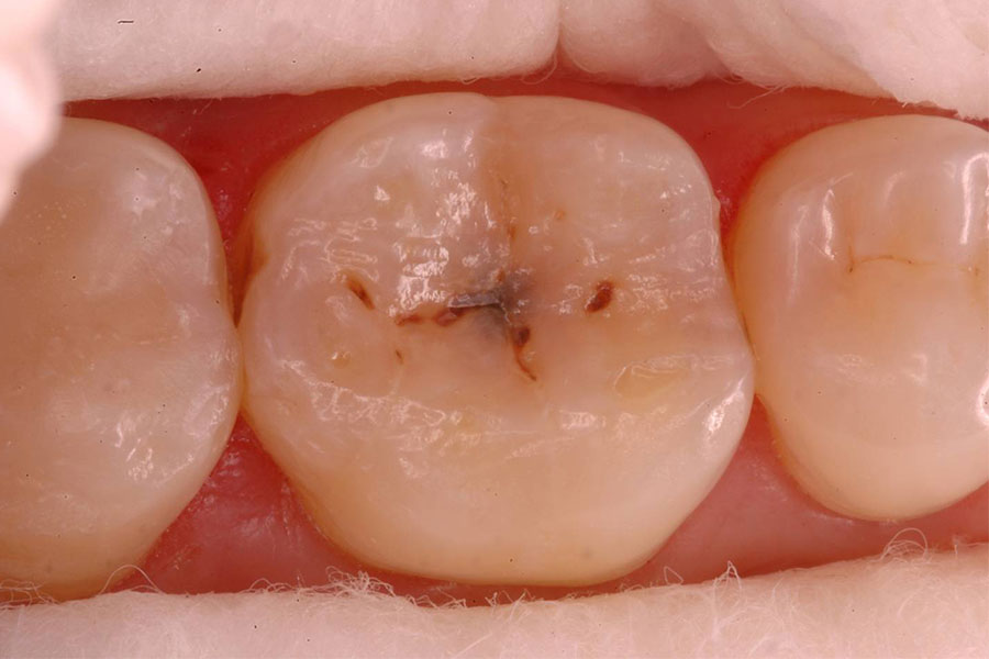 Dental Fillings