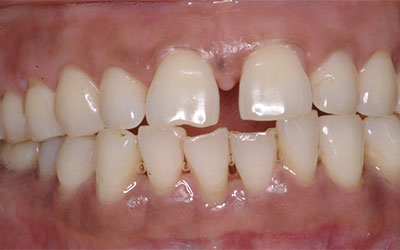Gaps Between front teeth