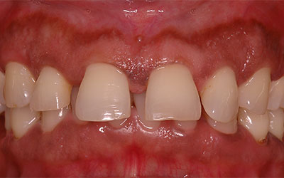 Gaps Between front teeth