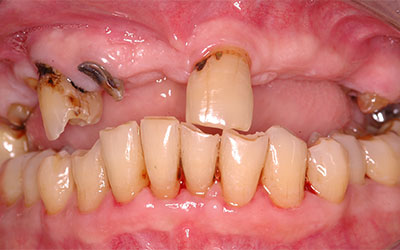 Missing Teeth