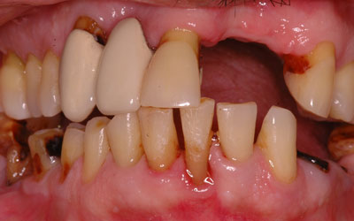 Missing Teeth