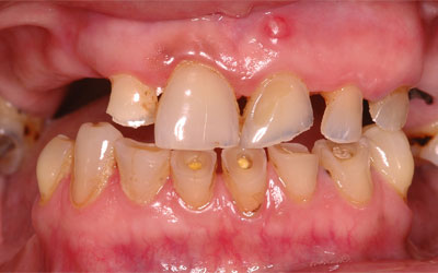 Missing Teeth