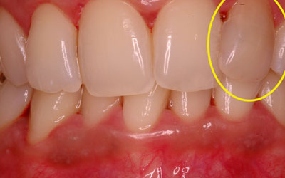 Non Vital Tooth