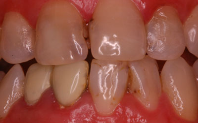 Noticing a Black Tooth