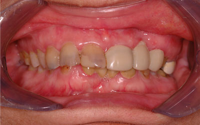 Noticing a Black Tooth