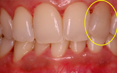 Noticing a Black Tooth