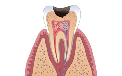 tooth sensitivity pain ice cream ,woman feeling tooth pain while eating sweets,dentist in Lokhandwala treating sensitive teeth