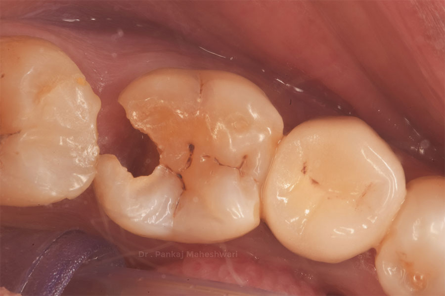 root-canal