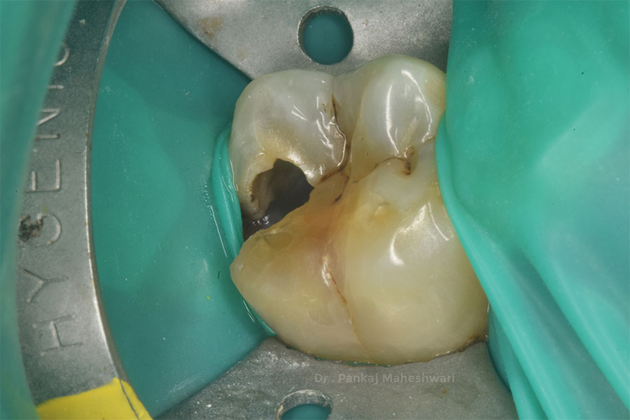 Root Canal