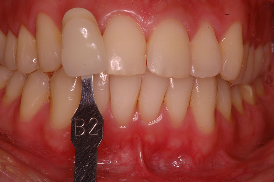 Dental cap