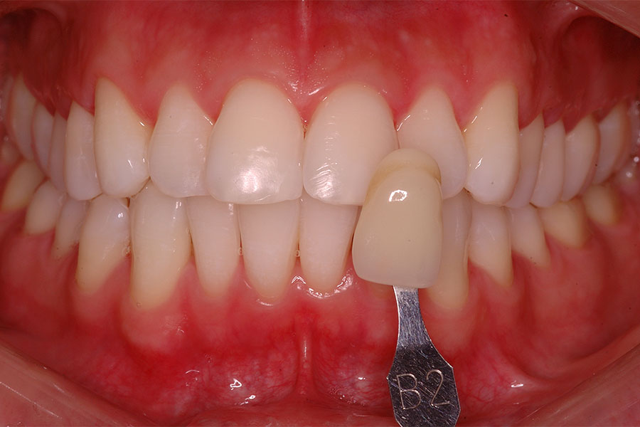 Dental cap