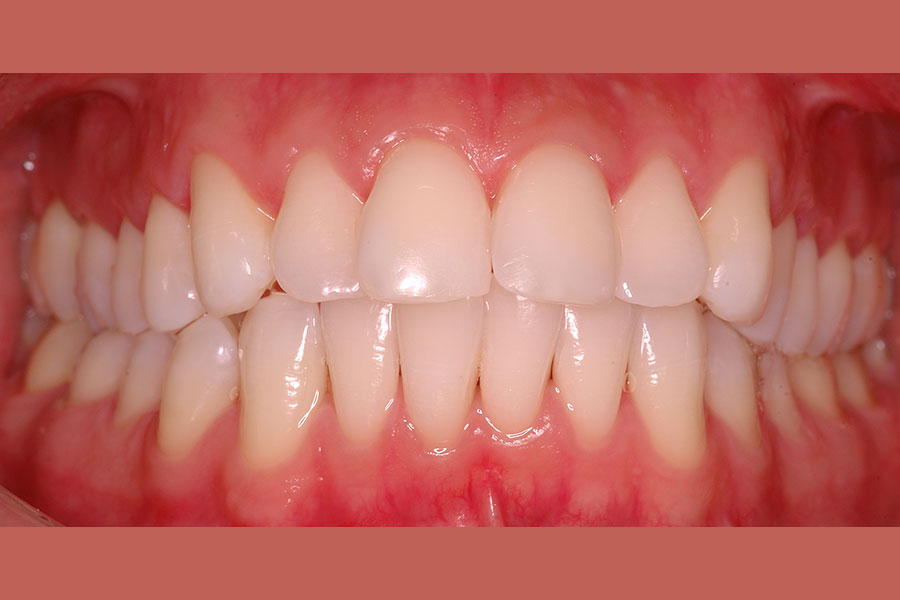Teeth Bleaching