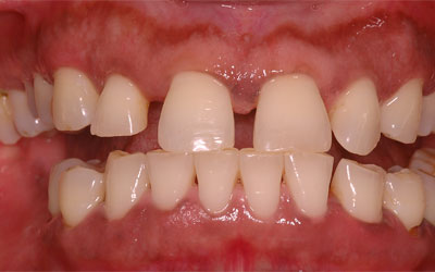 Teeth Projecting Out