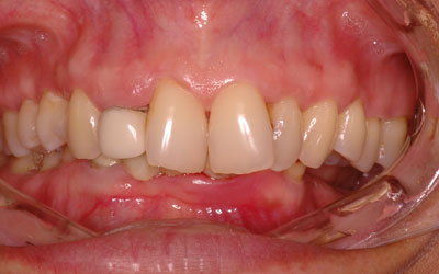 Teeth Projecting Out