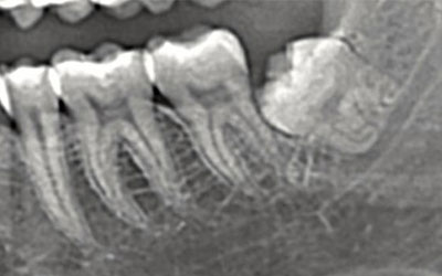 Wisdom Tooth