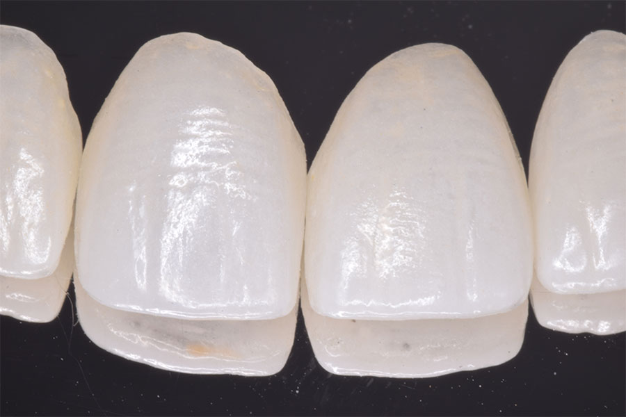 Close Front Tooth Gaps with Laminates