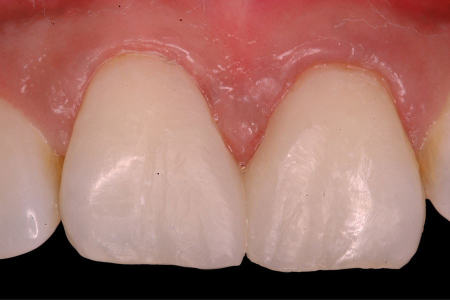 Close Gaps in a Day Diastema closure Composite