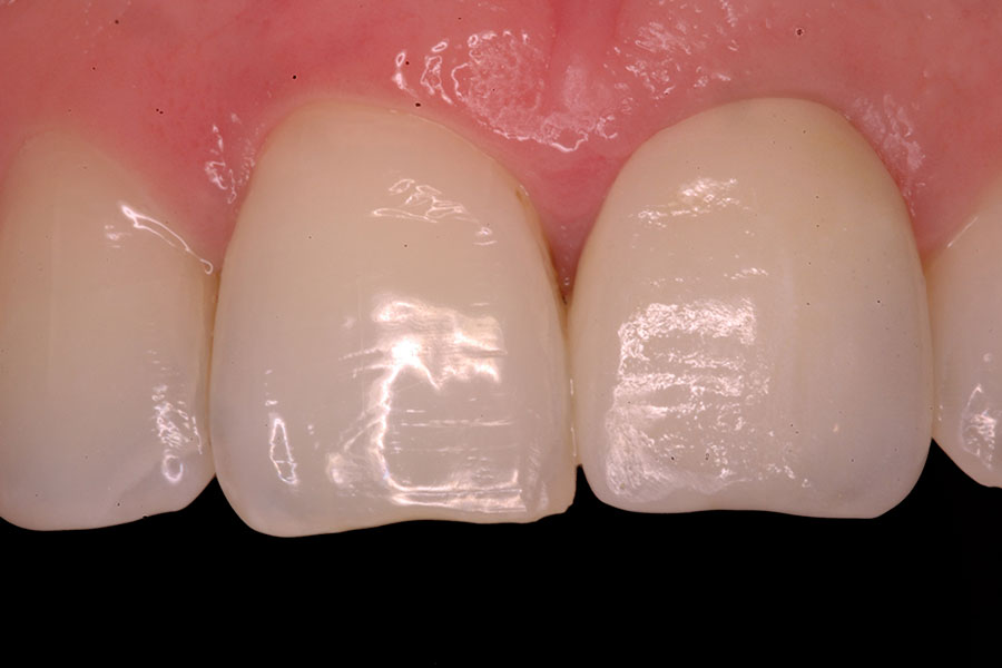 Dark stained teeth causes & solution