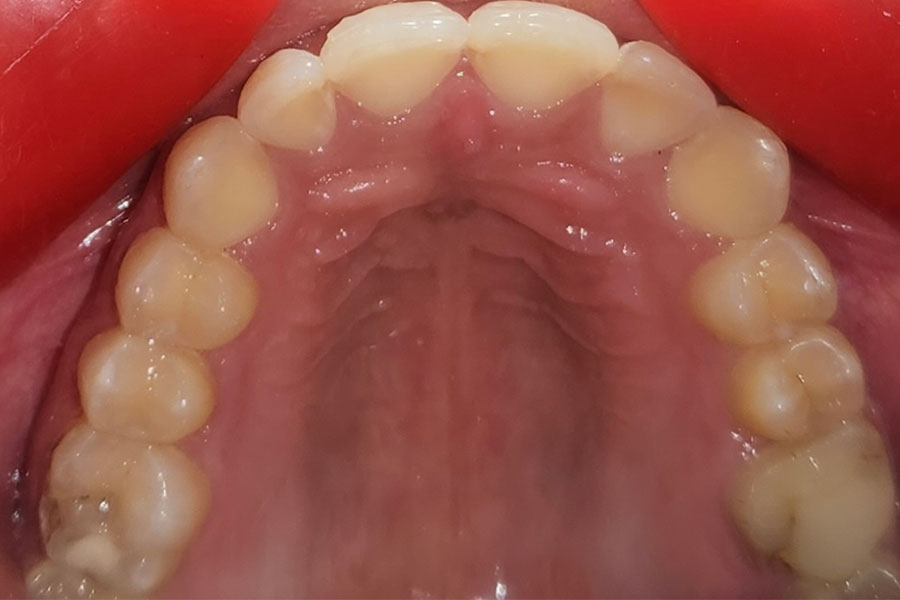 Close Front Tooth Gaps with Laminates