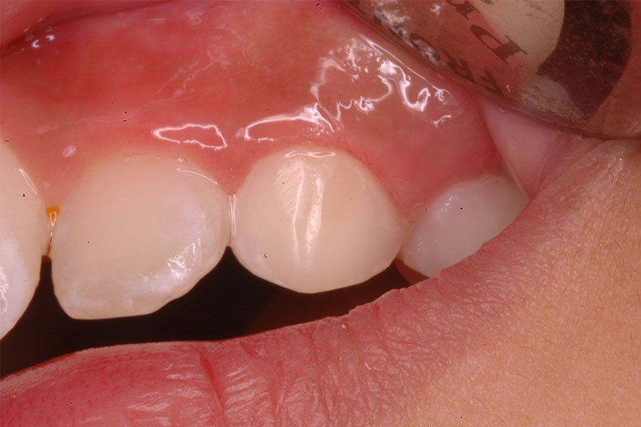 Dental Cavities in Children