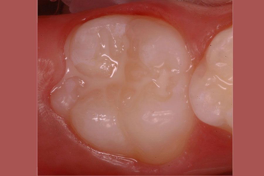 Fissure sealents