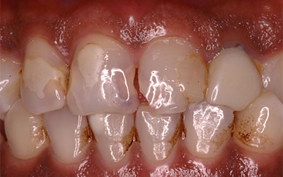Badly Broken Tooth