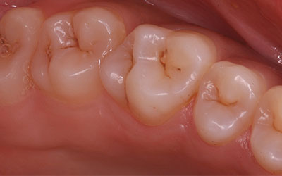 Black Spot on Tooth