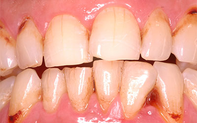 Black Spot on Tooth