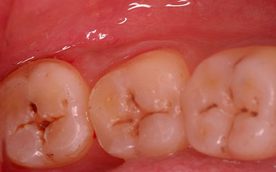 Dental Cavity