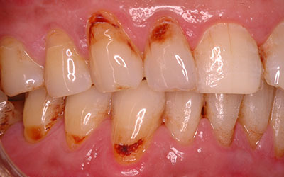 Dental Cavity
