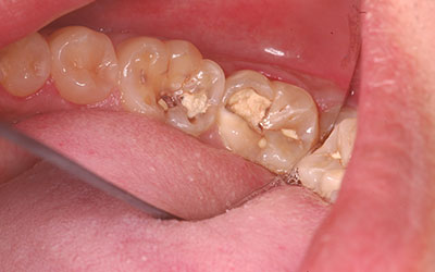 Food Getting Stuck in Teeth