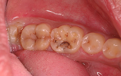 Food Getting Stuck in Teeth